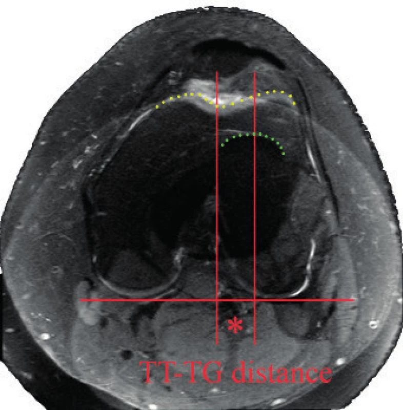 MRI sumace k hodnocení TT-TG distance – kontury trochley femuru a tuberosity tibie naznačeny, hvězdička určuje vymezení TT-TG distance.
Fig. 8. MRI summation to evaluate TT-TG distance – contours of the trochlea and tibial tuberosity marked, star mark showes TT-TG distance.