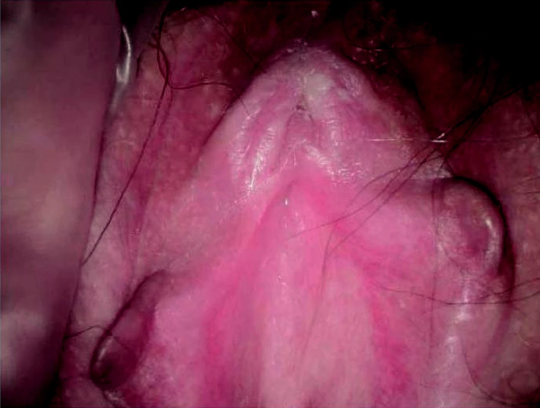 Bělavé ložisko hyperkeratózy periklitoridálně. Lichen sclerosus.