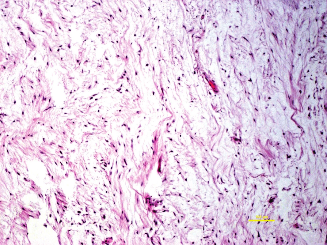 Myxoidní maligní nádor měkkých tkání může mít ošidně nevinný vzhled při přehledném zvětšení. Myxofibrosarkom grade 1, barveno hematoxylin-eozinem.