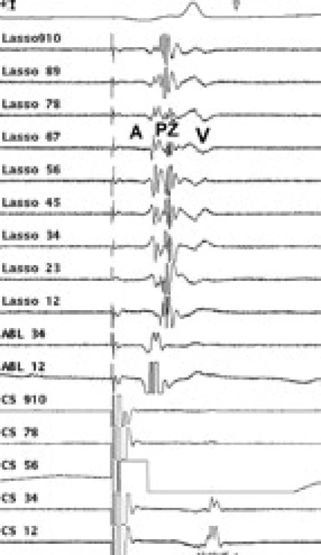Intrakardiální EKG záznam před RF ablací paroxyzmální FS – za stimulace z koronárního sinu. V Lasso katétru jsou téměř splynulé signály z levé síně (A) a plicní žíly (PŽ).