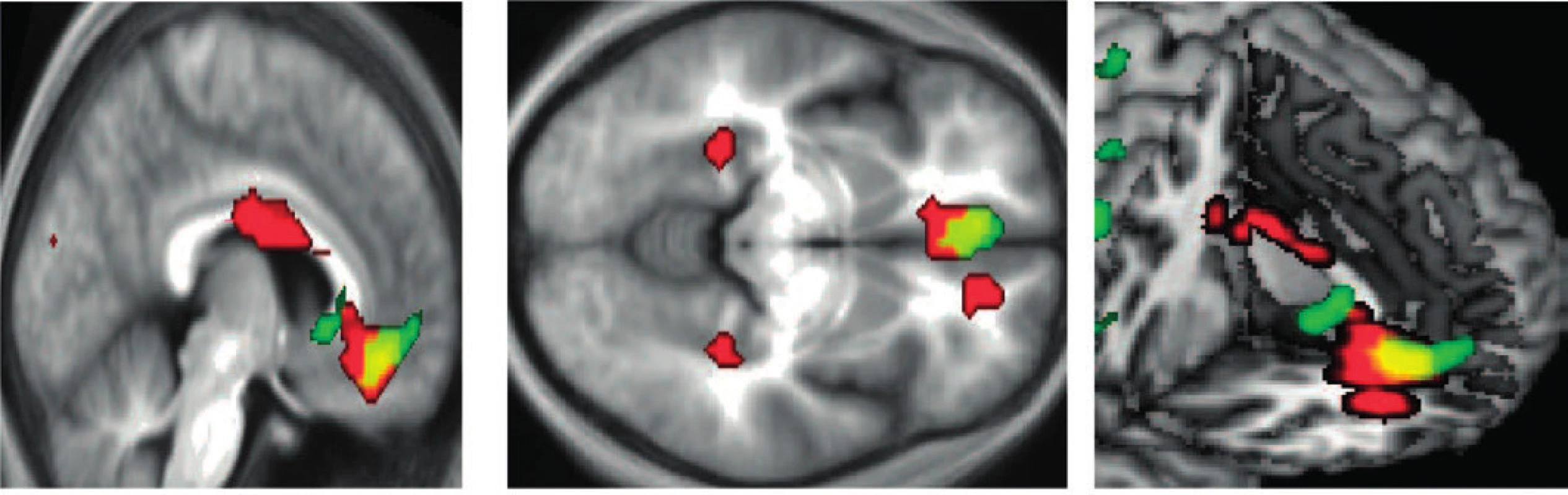 Aktivita mozku spouštěná zrakovými (červeně) a sluchovými (zeleně) podněty považovanými za krásné; konjukce aktivit (žlutě) (dle 22)