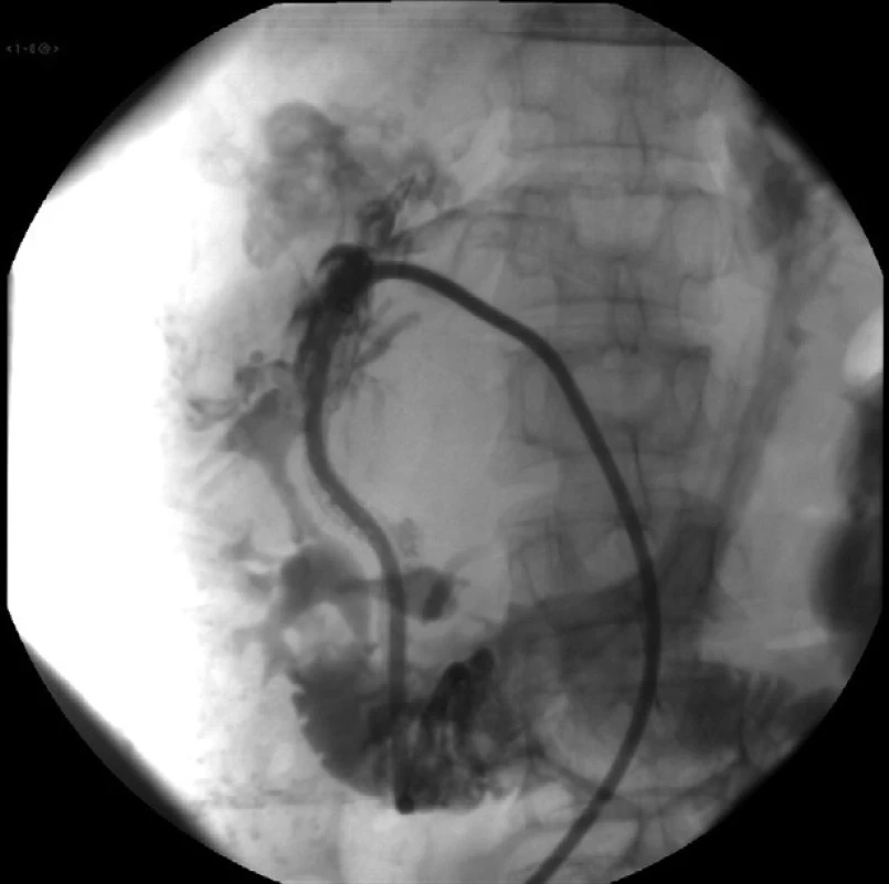 Upchatie poranenej arteria hepatica sinistra drenážnym katétrom hrúbky 12F
Fig. 6: Occlusion of injured left hepatic artery with a 12F drainage catheter