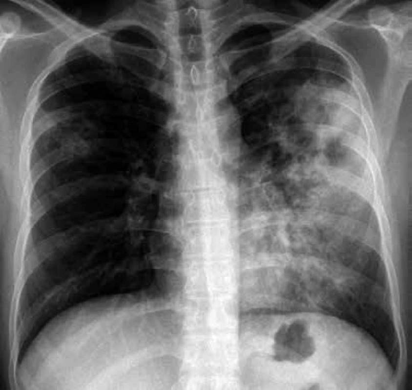 Zadopřední skiagram hrudníku u pacienta s rozsáhlou tuberkulózou plic
