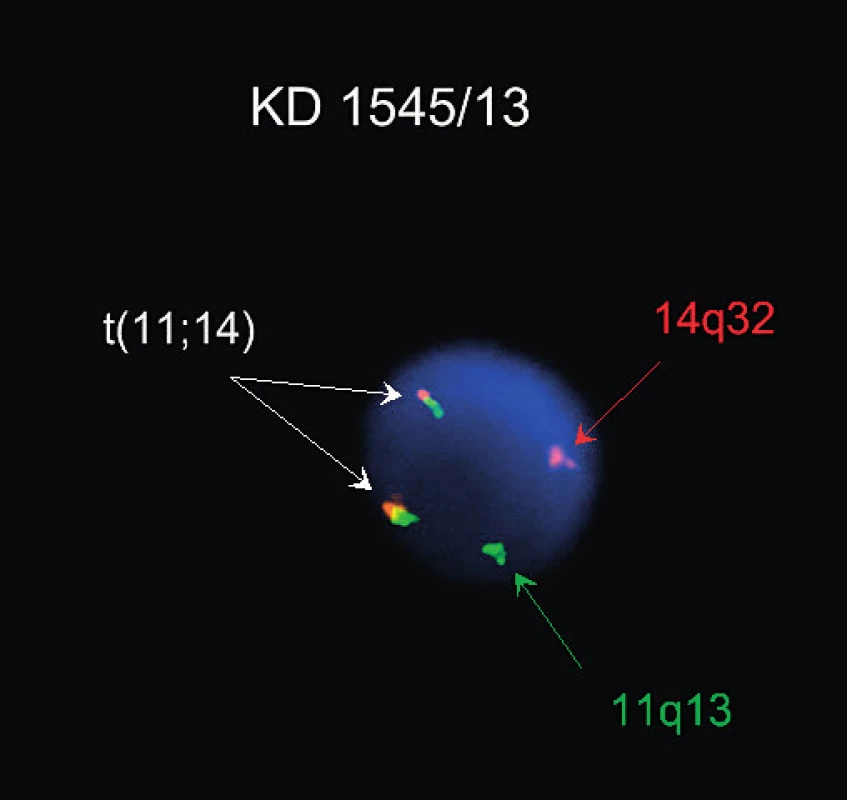Lymfom z plášťových buněk, t(11; 14), FISH (sonda Kreatech ON BCL1/IGH t(11;14)Fusion), fúzní signály translokovaných chromozomů jsou vyznačeny šipkou
(Publikováno se souhlasem CGB laboratoře a. s.)