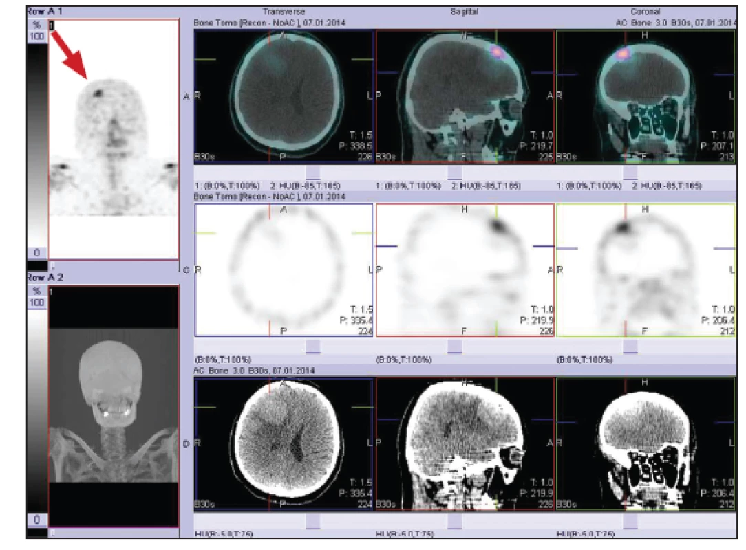 SPECT/CT hlavy. V CT obraze mozku je patrné hyperdenzní ložisko s perifokálním edémem a s útlakem frontálního rohu pravé postranní komory.