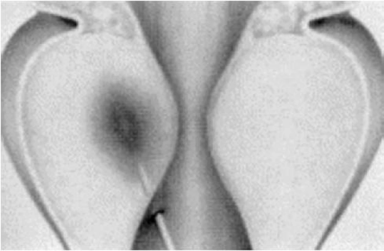 Schéma zavedení sondy do tkáně prostaty při ILC.