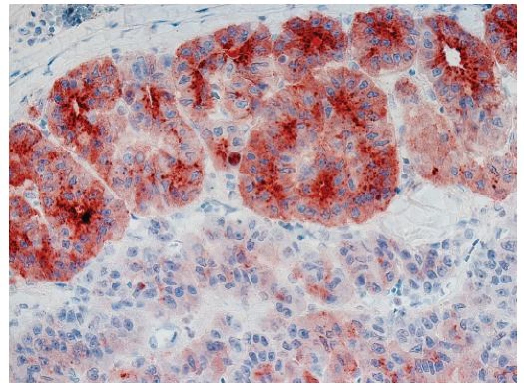 Hepatocelulární karcinom s fokálně pozitivním převážně kanalikulárním imunohistochemickým průkazem glypicanu-3. Zvětšení, objektiv 40x