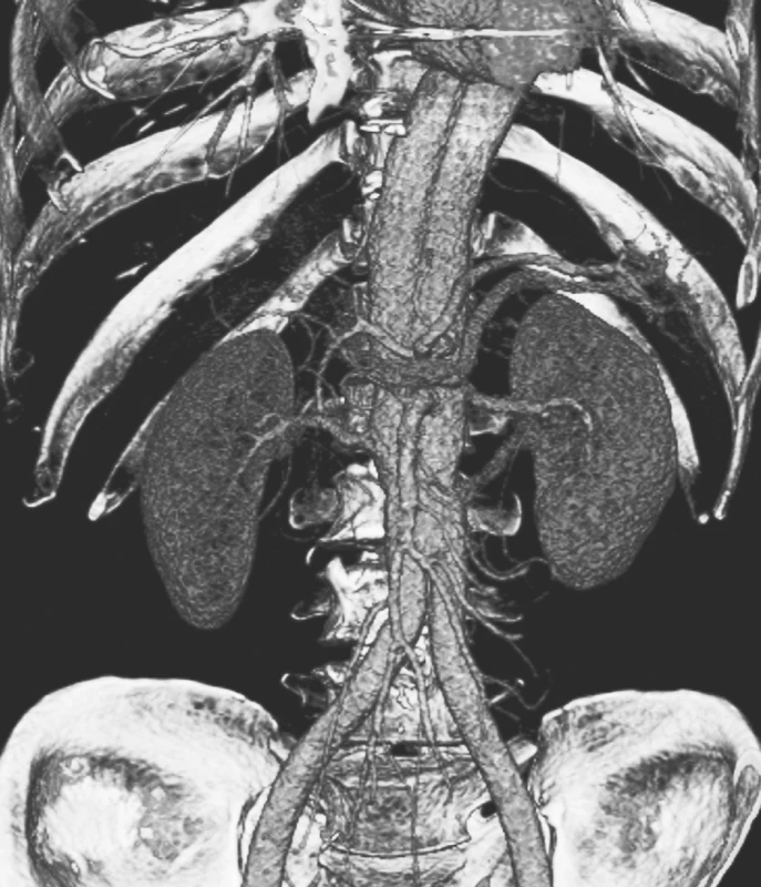 Detailní CTA obraz „double barreled aorty“ rok po resekci subrenální aorty technikou aortální fenestrace s ABI rekonstrukcí
Pic. 18. A detailed CTA view of the „double barreled aorta“ a year after the resection of the subrenal aorta using the technique of aortic fenestration with ABI reconstruction