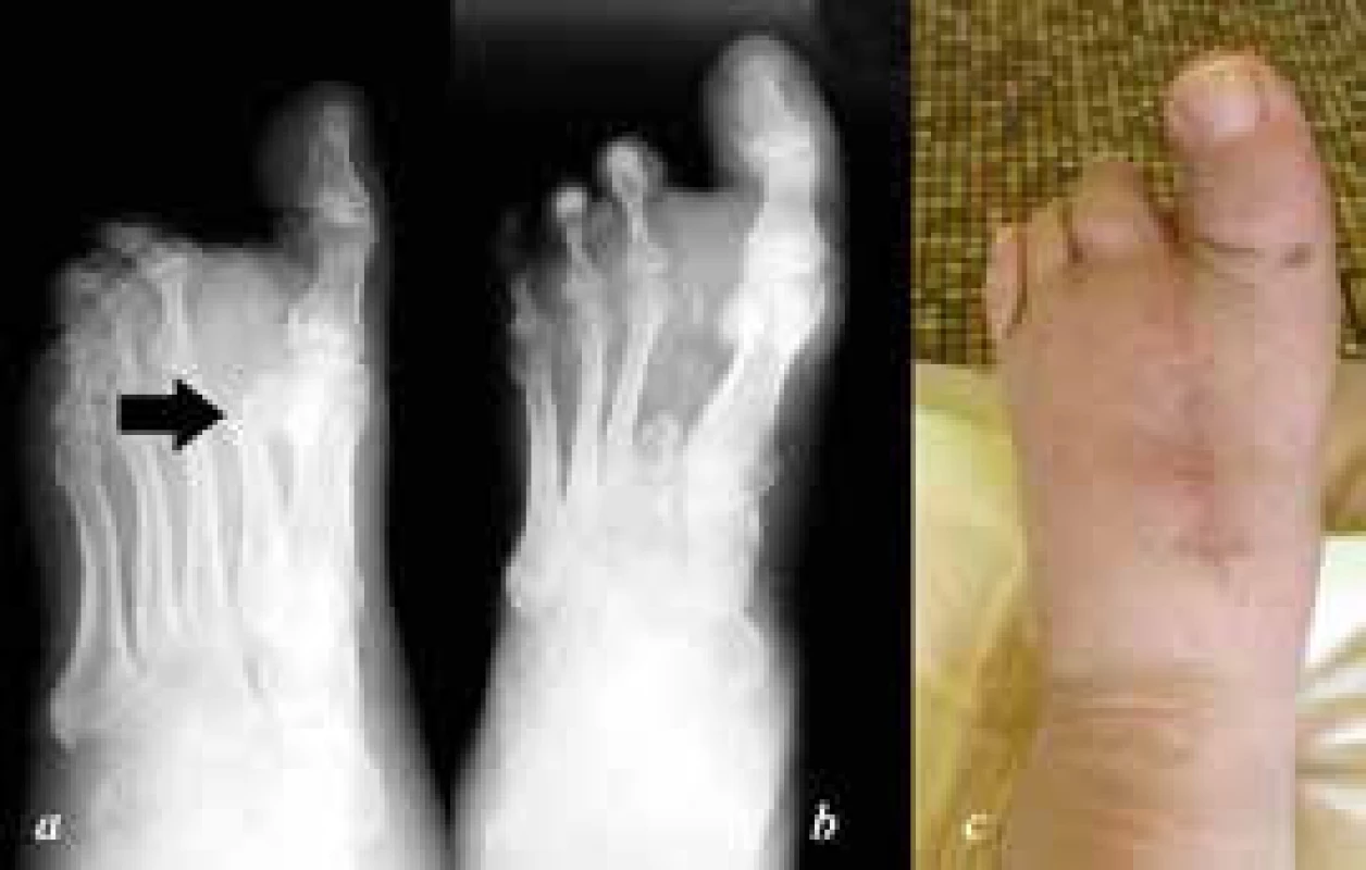 a: předoperační šikmý RTG nohy, stav po transmetatarzální amputaci II. paprsku na jiném pracovišti s osteolýzou apexu metatarzu 
b: pooperační dorzoplantární RTG nohy po resekci zbytku paprsku;
c: klinický snímek zhojené rány 3 roky po operaci