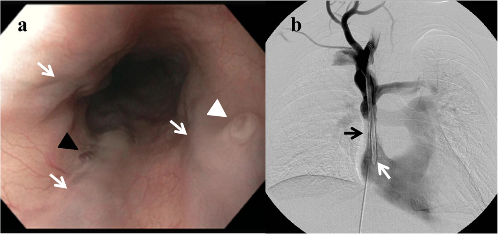 a Esophagogastroduodenoscopy in a patient with superior vena cava obstruction demonstrating varices in the proximal esophagus (white arrows), with overlying red wales (black arrowhead) and a fibrin plug (‘nipple sign’) (white arrowhead), indicating recent hemorrhage. b Venography of the superior vena cava showing a tunneled dialysis catheter (white arrow) with an adjacent superior vena cava stenosis (black arrow)