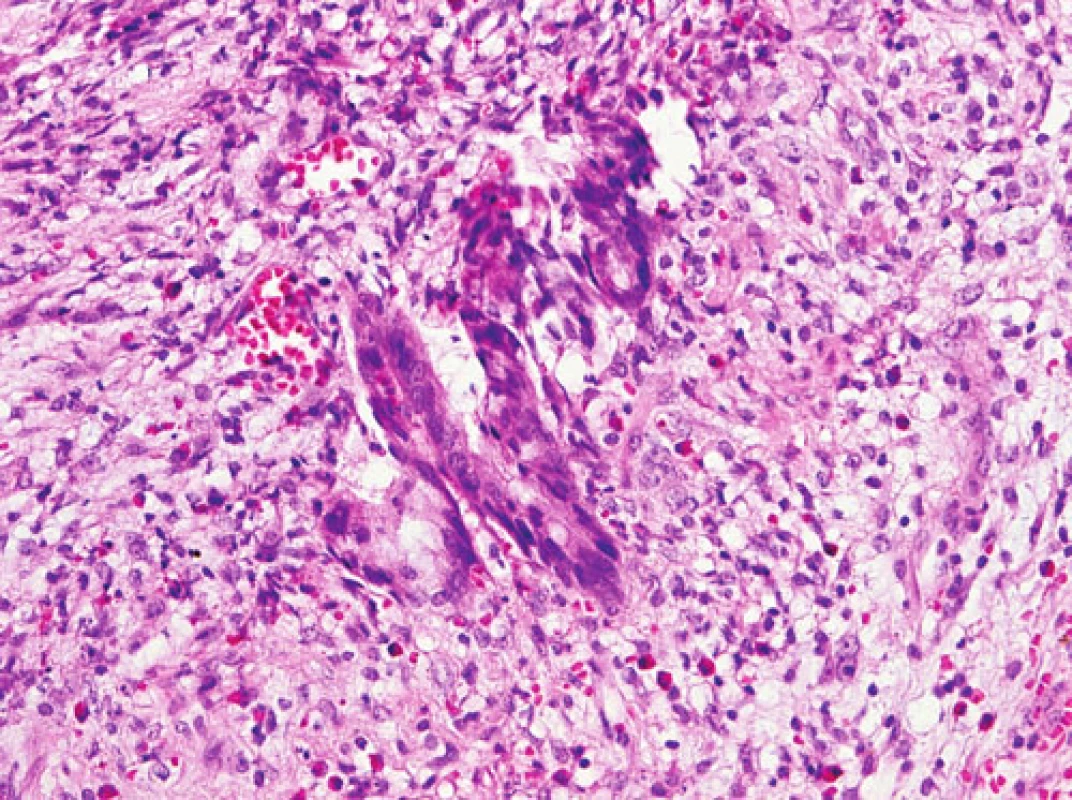 Nádorové žlázky infiltrující stěnu apendixu (HE, 240x)
Fig. 4. Tumor glands infiltrating the appendiceal wall (HE, 240x)