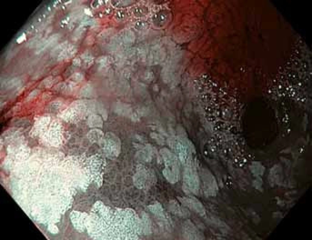 Gastroskopie v módu NBI – stejný pohled do antra žaludku s ložisky intestinální metaplazie, v levé dolní části obrázku je ložisko dysplazie vysokého stupně tmavší barvy s nepravidelnou povrchovou strukturou sliznice.