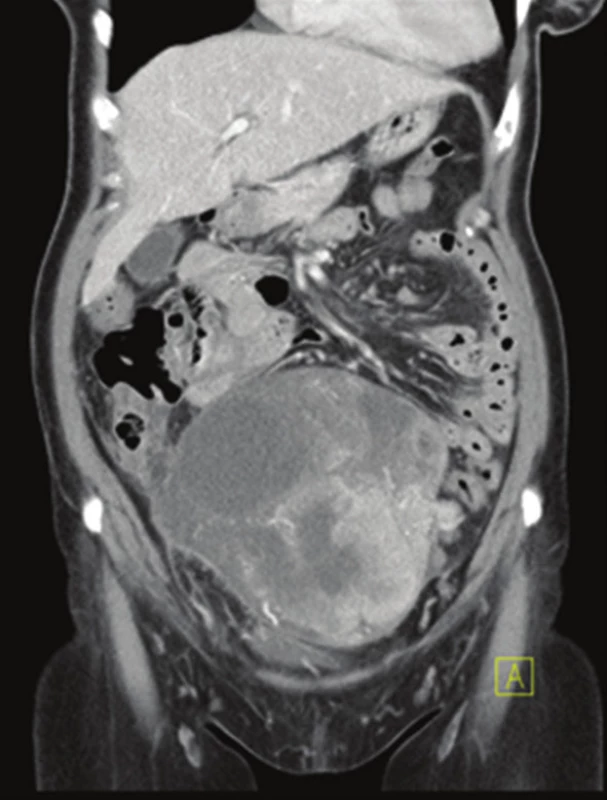 CT obraz objemného metastatického postižení pravého ovaria (venózní fáze – koronární řez)
Fig. 1: CT scan of large metastatic involvement of the right ovary (venous phase – coronal view)