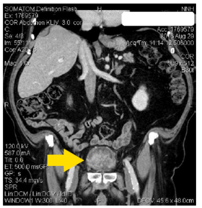 CT břicha s objemným tumorem močového měchýře
Fig. 1. CT scan of abdomen with large tumor of urinary bladder