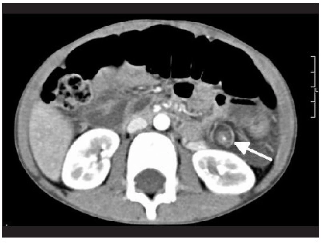 CT angiografia torzie lienálnej artérie s redukciou krvného prietoku
Fig. 5. CT angiography of splenic artery torsion with reducing blood flow