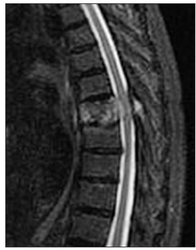 MRI (T2-vážené) hrudní páteře v sagitální rovině. Průkaz hemangiomu obratle Th7 s propagací do kanálu páteřního s kompresí míchy a myelopatií
Fig. 1. Sagittal MRI (T2-weighted) of thoracic spine. Detection of hemangioma of TH7, protruding into the spinal canal, spinal cord compression and myelopathy
