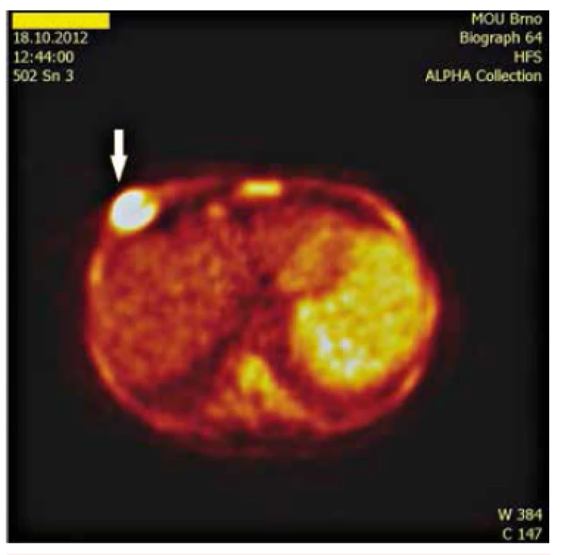 PET zobrazení nádorového ložiska v hrudní stěně.