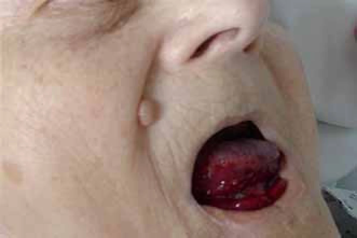 Krvácení do jazyka a spodiny dutiny ústní.