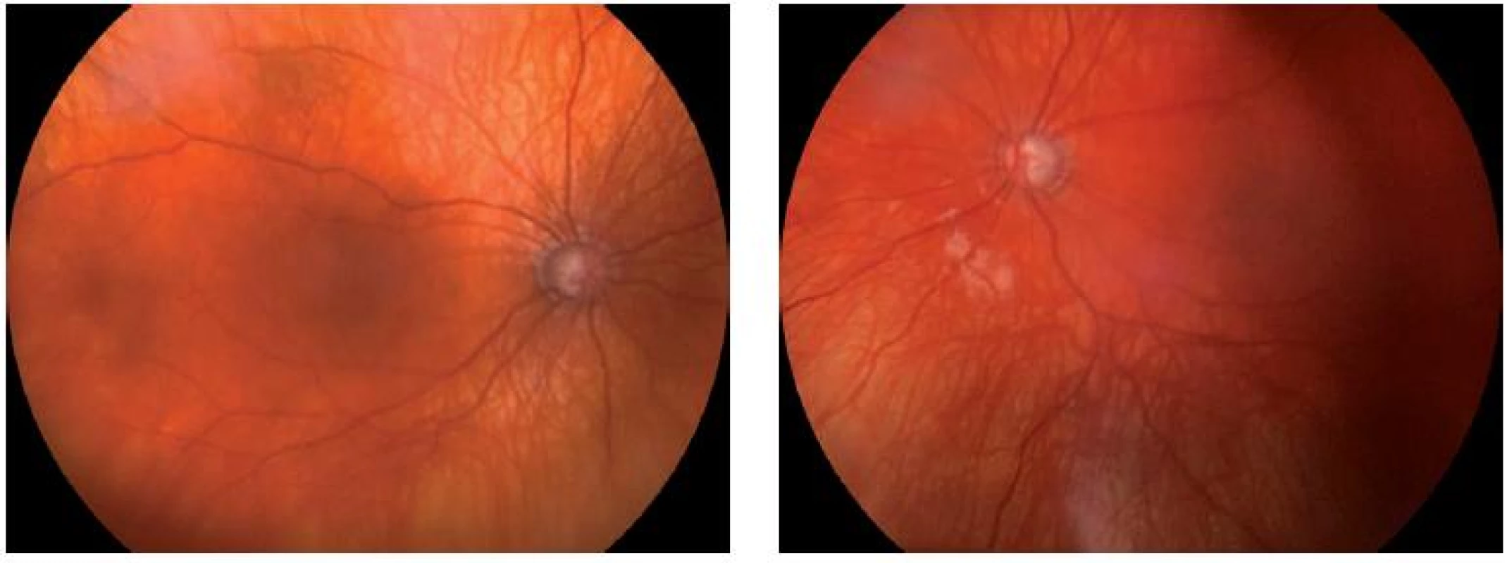 Oční pozadí u pacientky III-2: pravé (A) a levé (B) oko, glaukomové změny papily n.II, prořídnutí RPE.