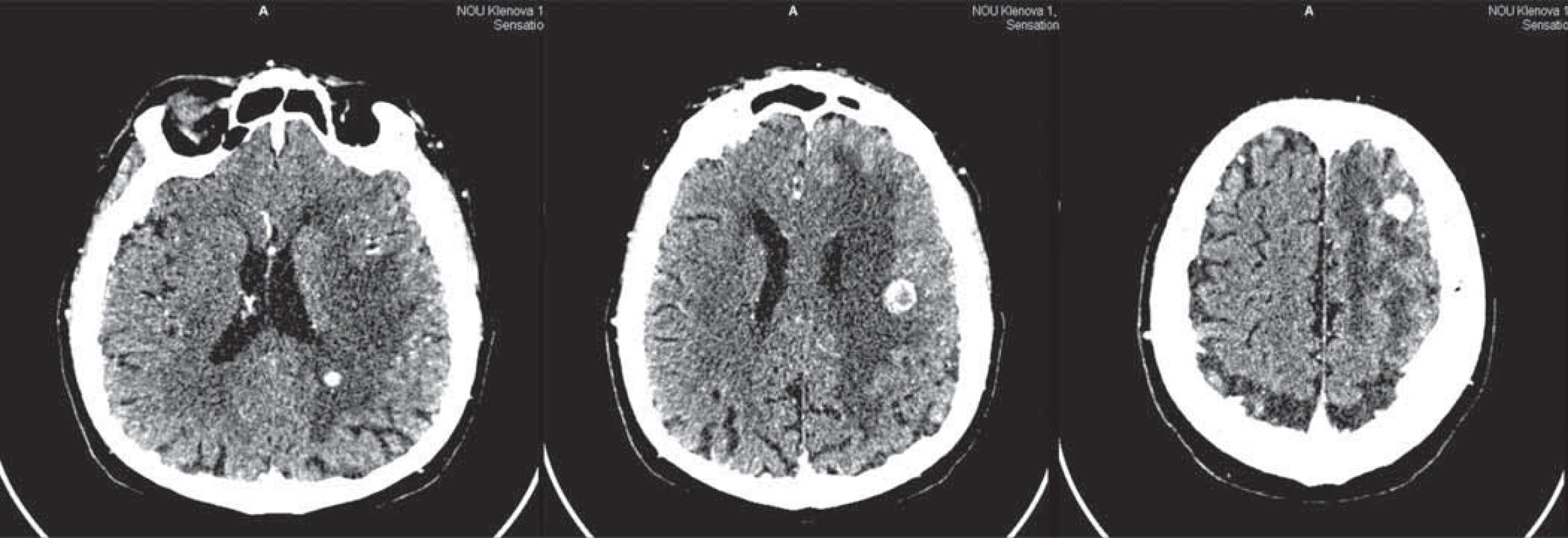 CT vyšetrenie mozgu 12. 7. 2009.