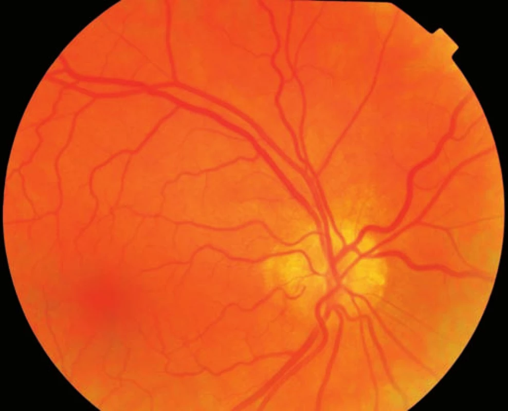 Fundus fotografia pravého oka (pacient č. 1). 
Viditeľné drúzy na povrchu papily zrakového nervu hlavne hore a nazálne, tortuozita nazálnych venóznych vetiev.