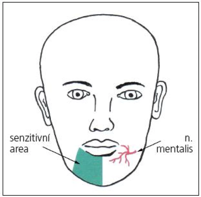 Schéma výstupu n. mentalis a area senzitivní inervace.