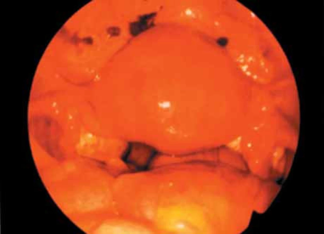 Ložiska endometriózy v malé pánvi.