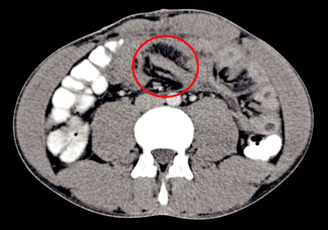 CT vyšetrenie – v kruhu je patologická rezistencia lokalizovaná nad duodéno-jejunálnym prechodom. Pri operácii sa zistilo, že sa jedná o organizovaný hematóm.
