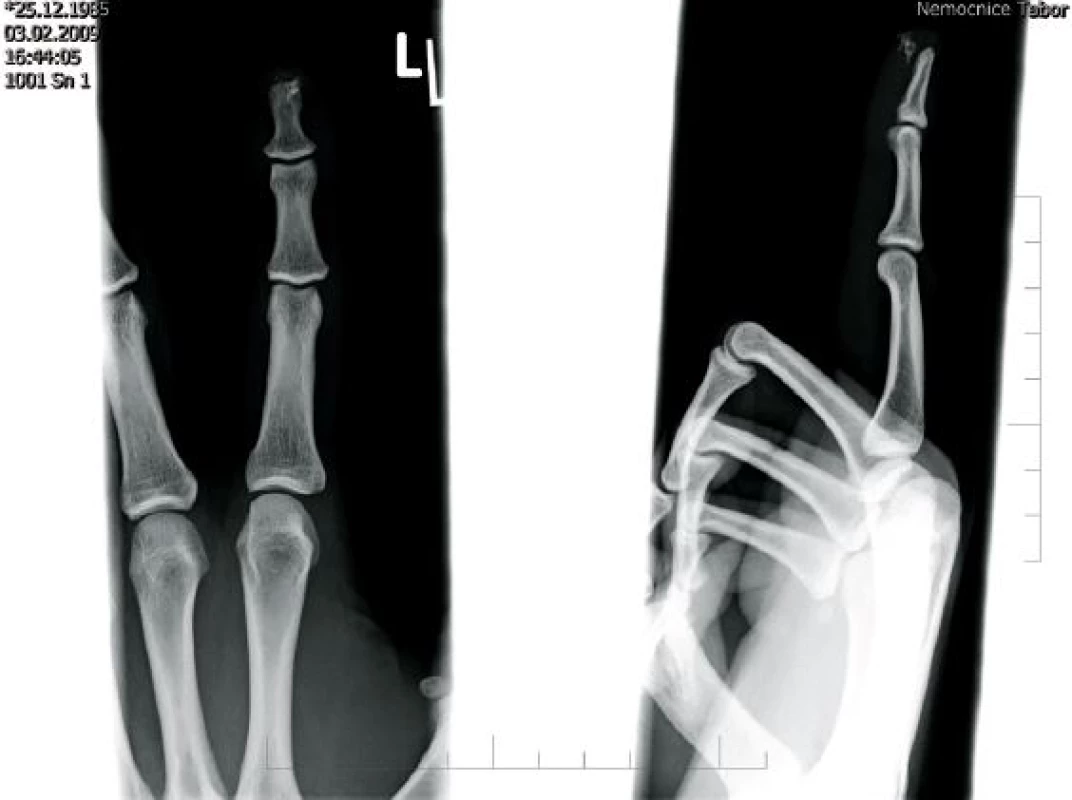 Rentgenový snímek 2. prstu pravé ruky s rentgen kontrasní látkou v oblasti apexu distálního článku