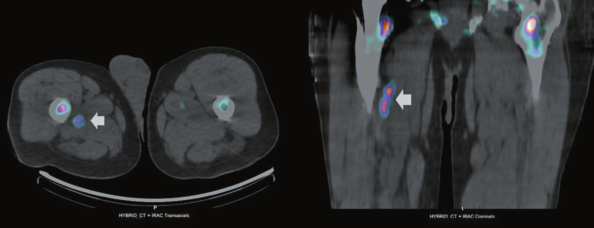 <i>Vyšetření značenými leukocyty, pozdní (24 hod) SPECT + low-dose CT, transverzální řez (vlevo) a koronární řez (vpravo).</i>
