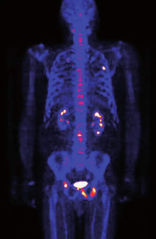 PET/CT vyšetření skeletu natrium fluoridem, 3/2012. Vysoká osteoblastická aktivita v osteosklerotické metastáze v 5. žebru vlevo v čáře zadní axilární. Podezření na drobnou metastázu v 7. žebru vpravo. Vysoká osteoblastická aktivita v osteosklerotické metastáze v levé polovině sacra. Vícečetné osteosklerotické metastázy s vysokou osteoblastickou aktivitou v dorzální části spodiny acetabula vpravo, ve stydkých kostech oboustranně, v sedacím hrbolu vlevo a dále velmi drobné metastázy i v ilických kostech oboustranně. V levé polovině obratlového těla Th4 drobné osteolytické ložisko s mírně zvýšenou osteoblastickou aktivitou. Játra a slezina nezvětšeny, v nativním CT vyšetření bez ložisek. Žlučové cesty štíhlé. Patrně parapelvické cysty v levé ledvině, jiné změny na obou ledvinách nejsou patrné. Pankreas se známkami počínající tukové atrofie. Obě nadledviny a močový měchýř bez zřetelných patologických změn. Prostata nezvětšená.