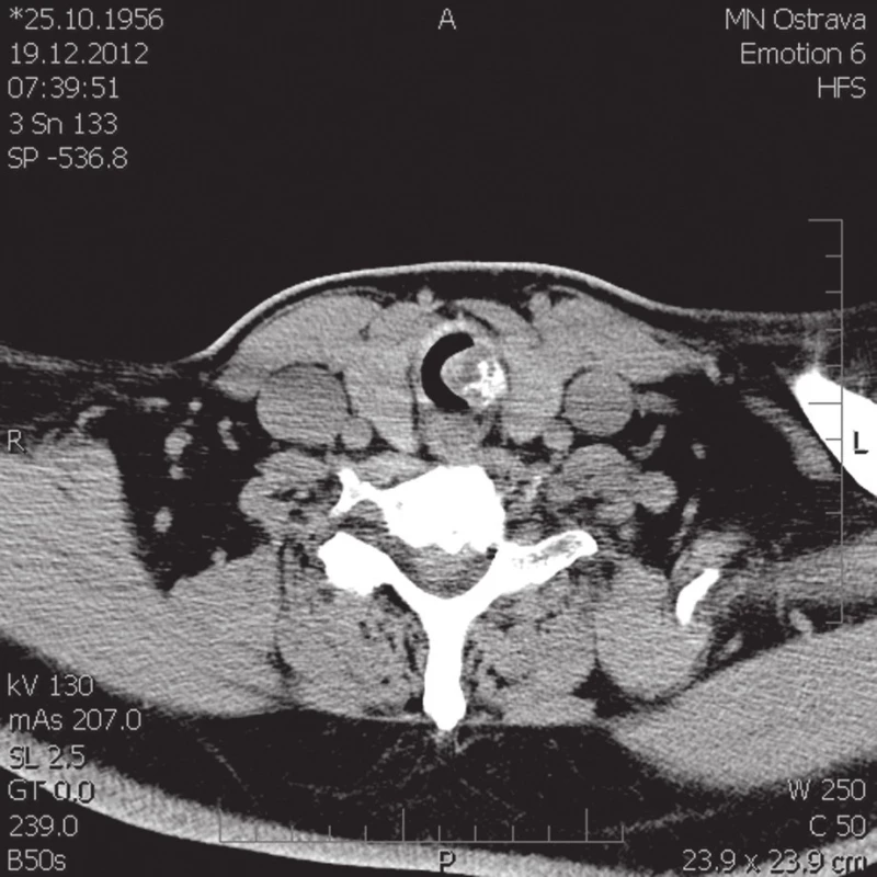 Předoperační CT - obraz hladkého vyklenutí z levé části prstencové chrupavky o denzitě 55 HU zasahující přes střední čáru.