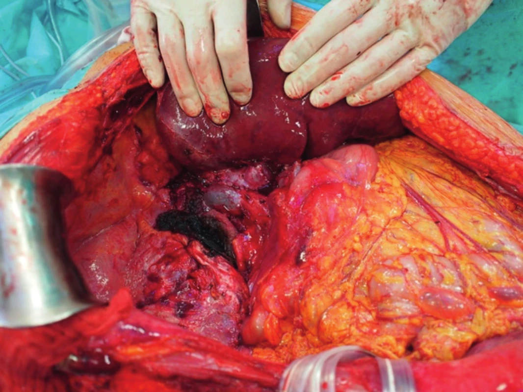 Transplantace jater - anastomóza dolní duté žíly „side-to. side“.