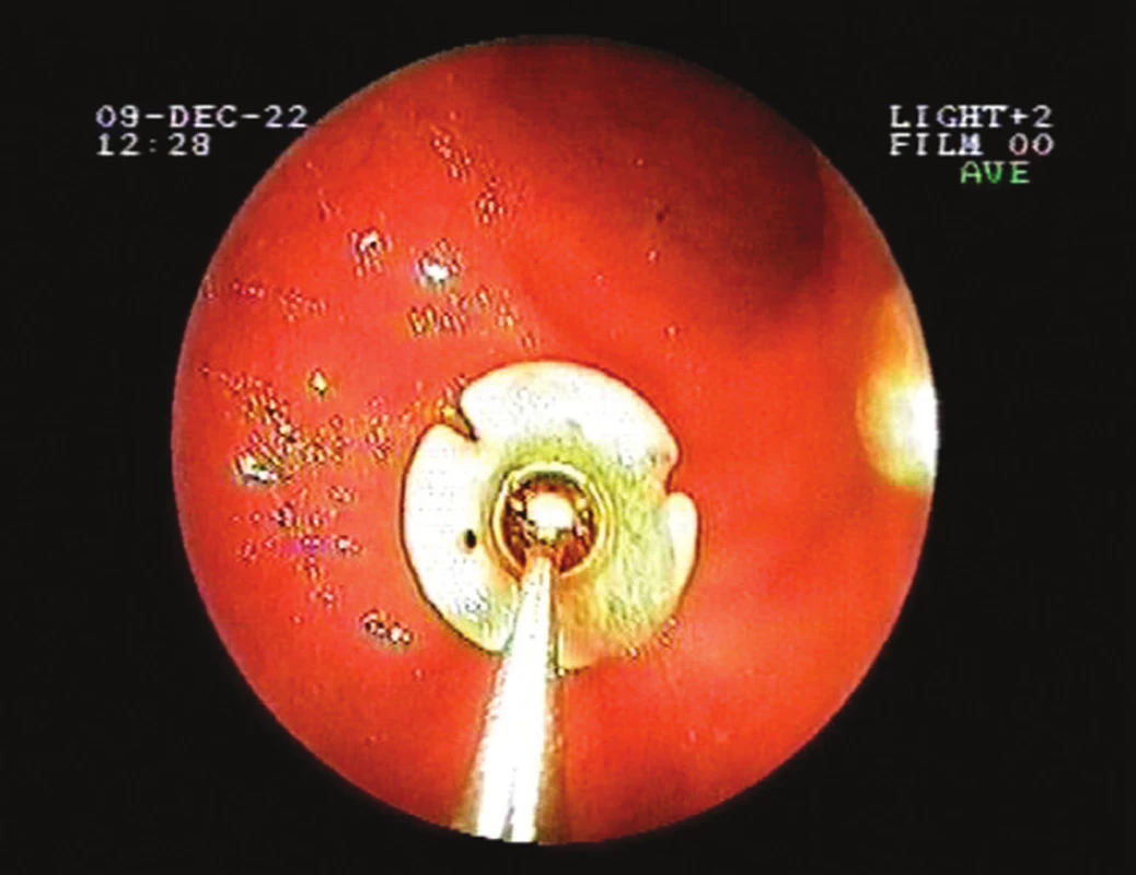 Endoskopický pohled – normální pozice fixační plošky
Fig. 1. Endoscopic view – the normal position of retention plate