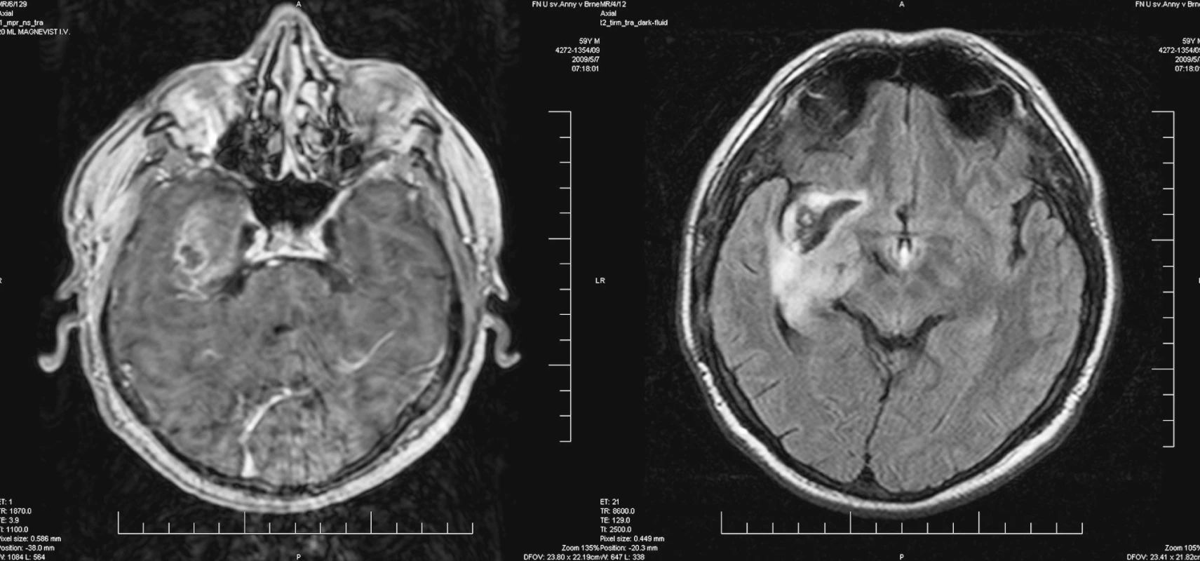 Vyšetření MRI – průkaz sytící se nádorové tkáně na bázi temporálního laloku (vlevo), další ložisko prokrvácení v oblasti inzuly
Pic. 4. MRI – enhancing tumor tissue affecting temporal lobe base (left picture), another bleeding focus affecting insula