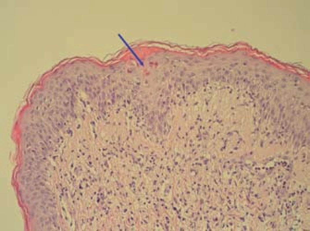 Inflamatorní lichenoidní léze s bazální spongiózou a disperzní apoptózou keratinocytů (označeny šipkou), dermální smíšený reaktivní infiltrát-bioptický vzorek kůže (HE, zvětšení 200×).
Fig. 5. Inflammatory lichenoid lesions with basal spongiosis and dispersed apoptosis of keratinocytes (marked by arrow), dermal mixed reactive infiltrate – bioptic skin sample (HE, magnification of 200×).