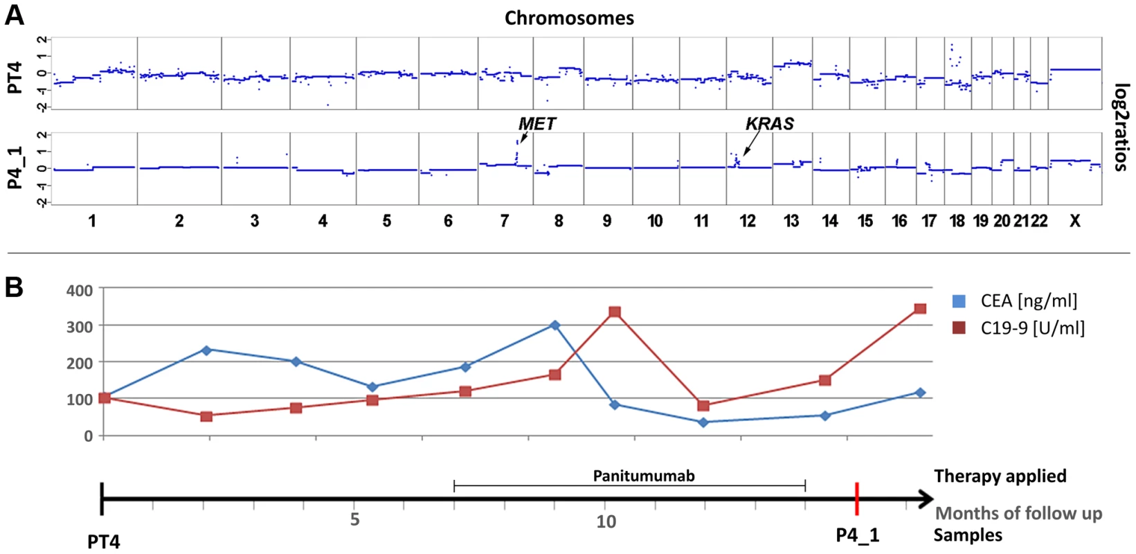 Co-occurrence of amplifications of the <i>KRAS</i> and <i>MET</i> genes observed after 7 months of treatment with panitumumab in patient #4.