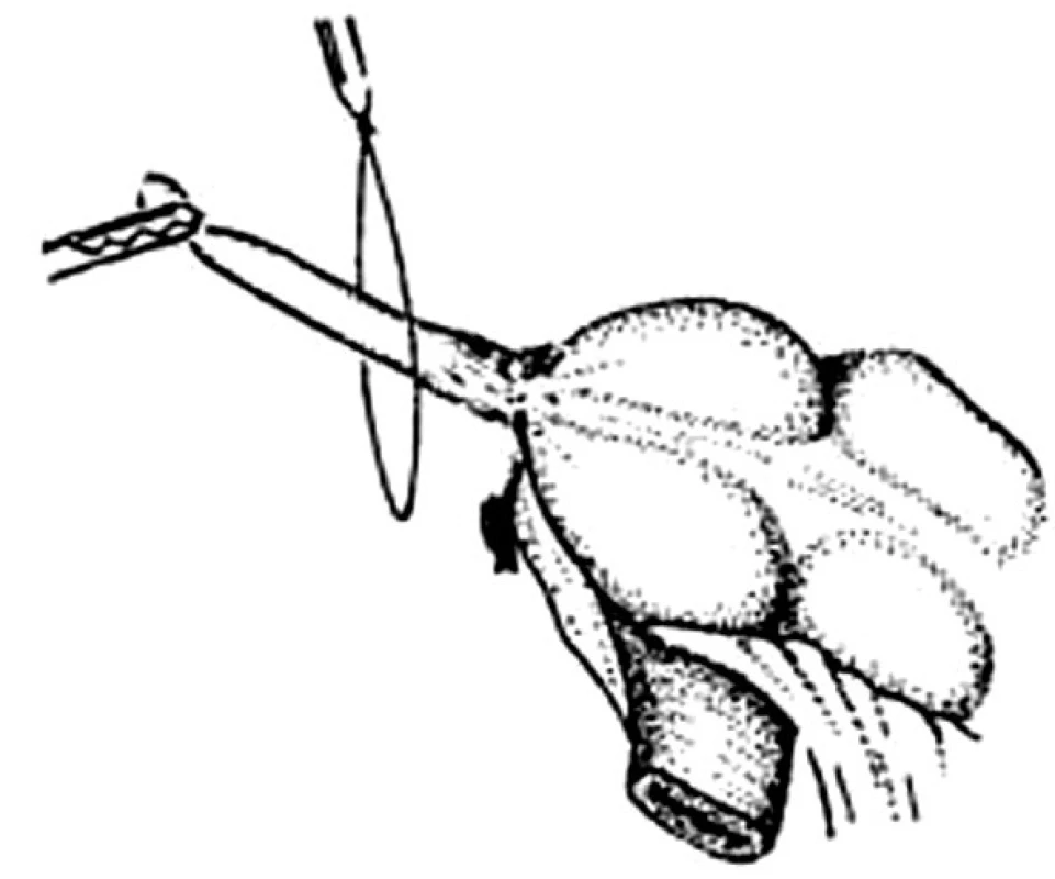 Laparoskopická apendektomie, naložení smyčky na červ
Fig. 5. Laparoscopic appendectomy, the loop is placed over the appendix