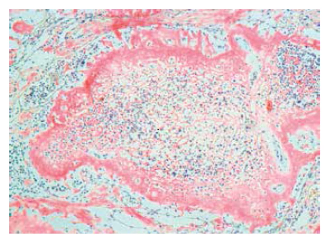 Lymfatická uzlina – histologický nález, Kongo červeň. Zvětšení 100x. Základní struktura lymfatické uzliny je zcela setřena Kongo pozitivními depozity.