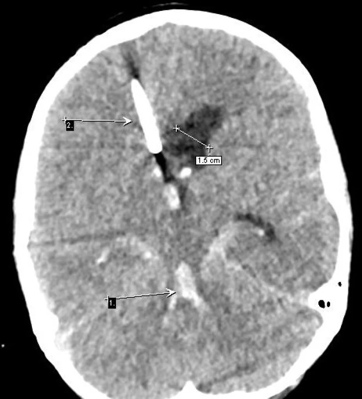 Hemocefalus s denzní krví ve 4. komoře (1) a nitrokomorová drenáž frontálního rohu vpravo s dilatací vlevo, SAK s hyperdenzními lemy akutní hemoragie