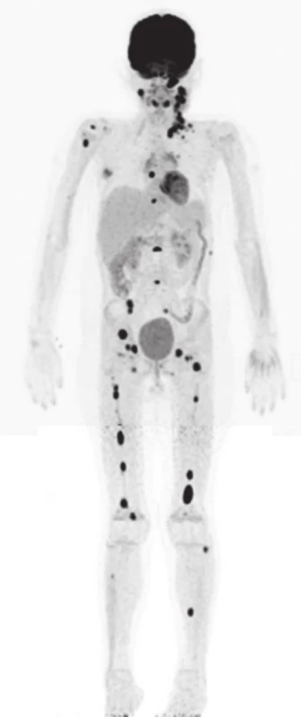 Celotelové PET/CT s &lt;sup&gt;18&lt;/sup&gt;F-FDG. Mnohopočetné metastázy v kostnej dreni, lymfatických uzlinách krku bilat. a supraklavikulárnej oblasti vľavo, infiltrácia ľavej sfenoidálnej a maxilárnej dutiny. (SUVmax: 9-15). [19.02.2014]