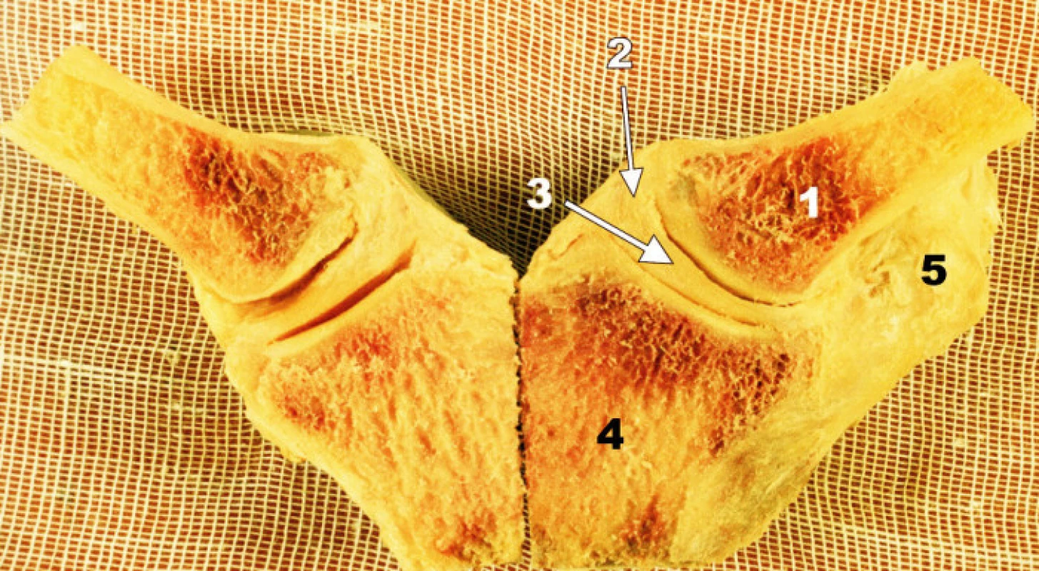 Frontální řez oběma SC klouby. 1 – mediální konec klíčku, 2 – kloubní pouzdro, 3 – discus intraarticularis, 4 – manubrium sterni, 5 – lig. costoclaviculare Fig. 2. Coronal section through both SC joints. 1 – medial end of the clavicle, 2 – joint capsule, 3 – intraarticular disc, 4 – manubrium sterni, 5 – costoclavicular ligament