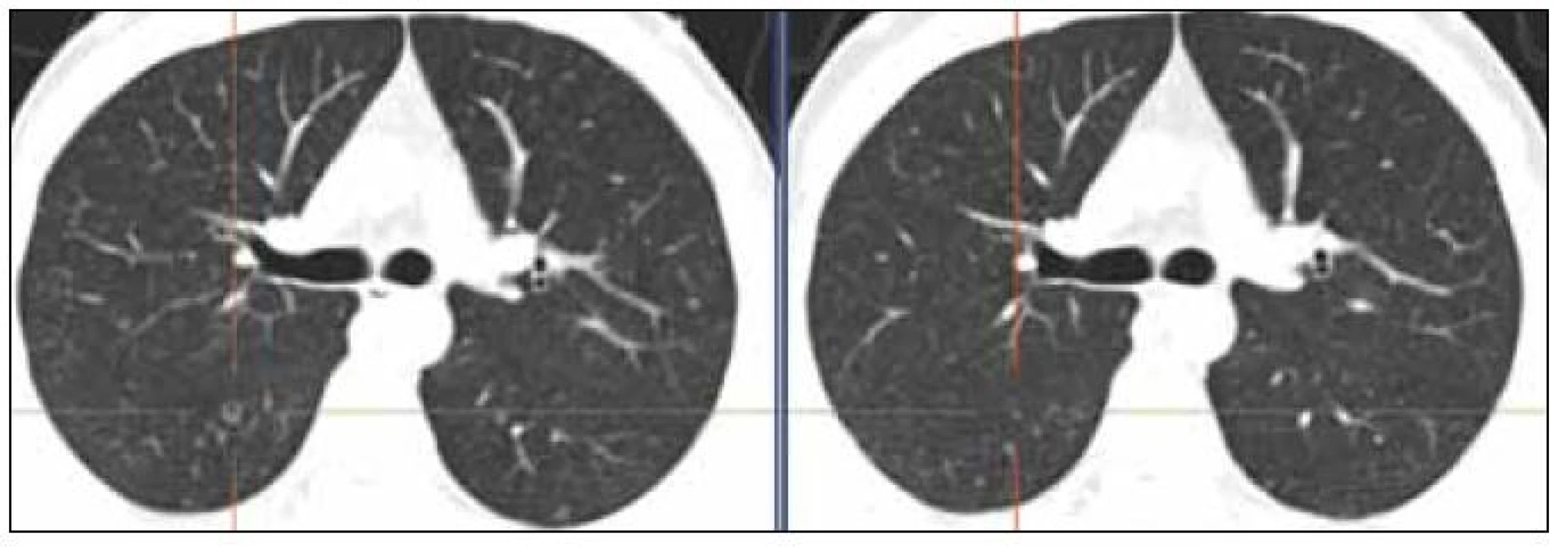 Ilustrativní snímky plicního parenchymu. Před léčbou – snímek vlevo 10/2010 (cystoid), po 4. cyklu léčby – snímek vpravo 1/2011 (jen nenápadná nodularita). Zmenšily se i 2 drobné opacity v levém plicním křídle ve stejné etáži dorzálně a laterálně.