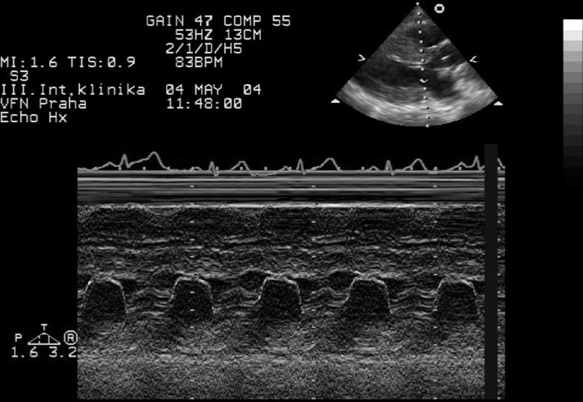 Jednorozměrná echokardiografie – hypertrofická obstrukční kardiomyopatie Typický pohyb předního cípu mitrální chlopně s naznačením abnormálního dopředného pohybu závěsného aparátu v systole.