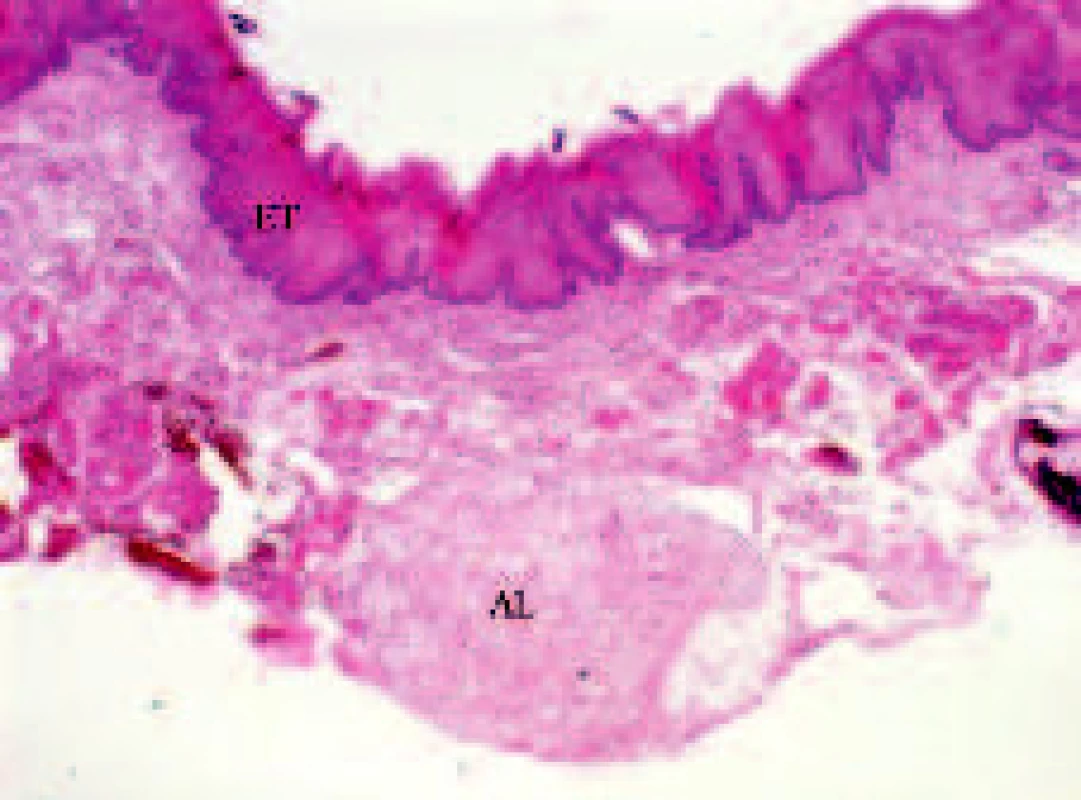 Histologicky normální epitel jazyka s nevelkým fuligem, pod ním podslizniční pojivo a dole drobný nádorový uzel atypického lipomu (H.E. = hematoxylin-eosin; zvětšeno 2x).