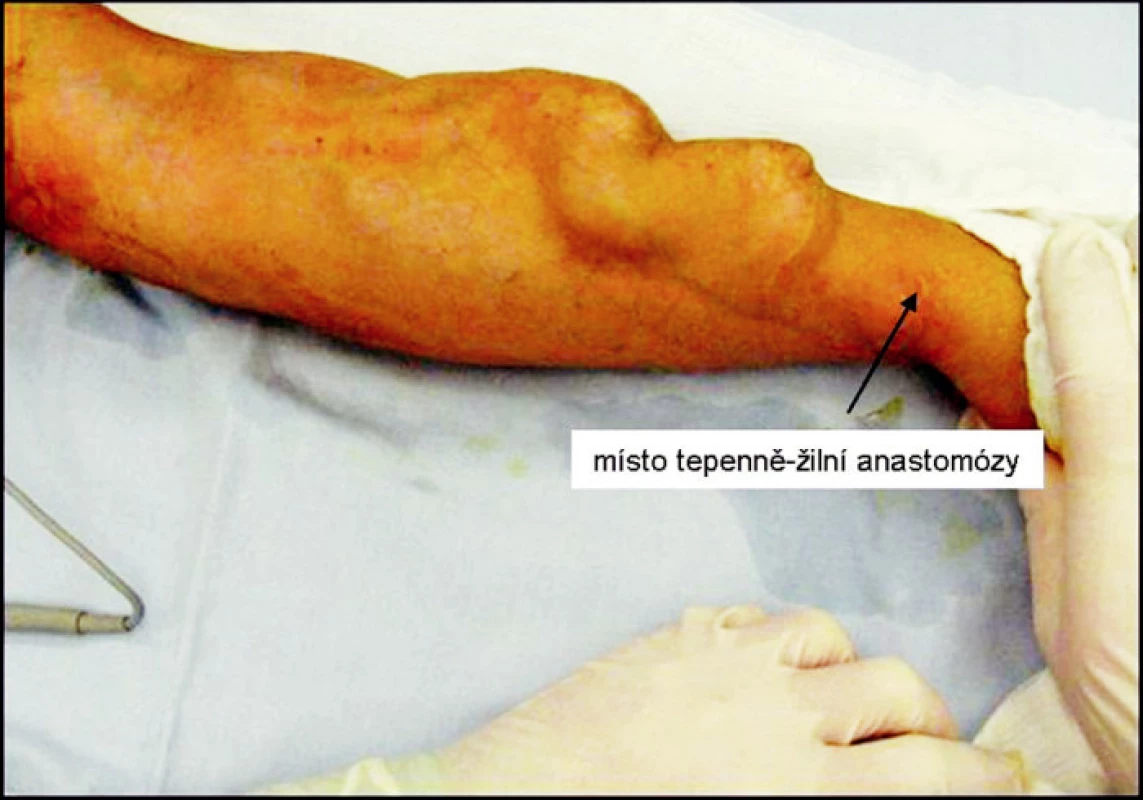 Pseudoaneuryzma radiocefalické píštěle 9 let od založení, šipka znázorňuje místo anastomózy
Fig. 5. A pseudoaneurysm of a radiocephalic fistule 9 years following its completion, the anastomosis is marked by an arrow