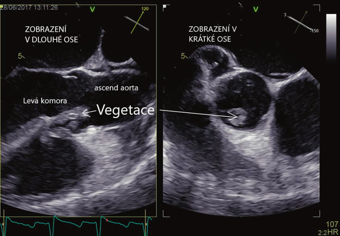 Infekční endokarditida, vlající vegetace na aortální chlopni. Vyšetření jícnovou echokardiografií
