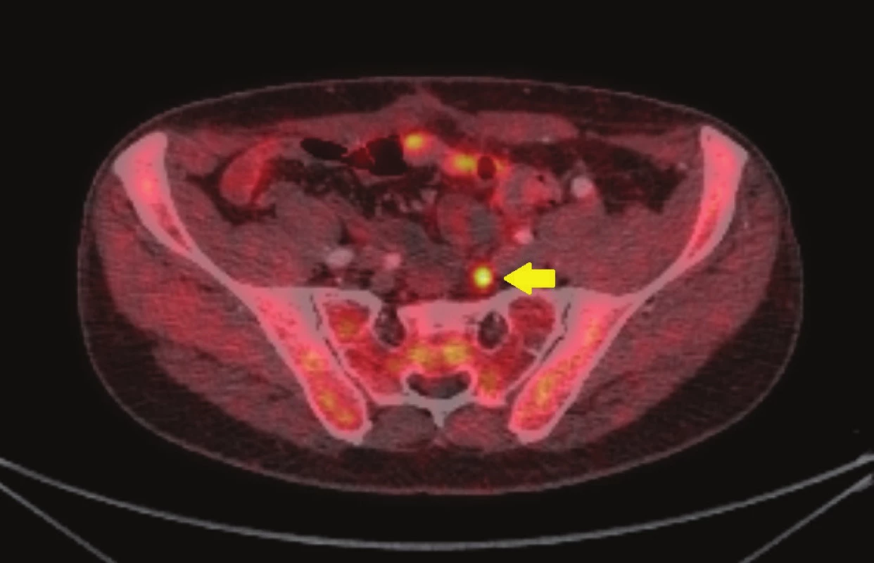 18F-cholin-PET/CT: transaxiální fúze PET/CT obrazu zobrazující vyšší aktivitu radiofarmaka v ilické lymfatické uzlině (žlutá šipka)
Fig. 1: 18 F-choline PET/CT: transaxial PET/CT fusion image demonstrating focal tracer uptake in iliac node (yellow arrow)