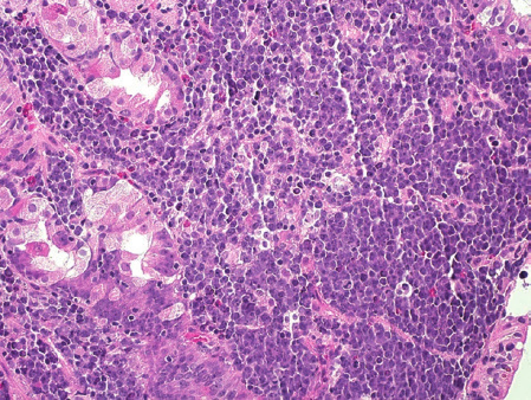 Pacient 8. Obraz dárcovského lymfomu odpovídající Burkittově lymfomu, biopsie žaludeční sliznice infiltrované nádorem.
Barveno hematoxylinem a eosinem (původní zvětšení 200x).