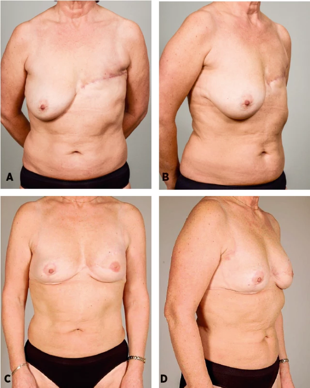 Patient 3: A 53-years-old women 18 mounts after mastectomy and adjuvant radiotherapy. She was not considered a good candidate for a DIEP flap breast reconstruction because she was very thin and a strong smoker. She underwent latissimus dorsi breast reconstruction associated with fat grafting into the pectoralis muscle (50 ml), and with abdominal advancement flap (allowing to reduce the size of the skin paddle and thus the length of the scars on her back). One additional session of lipomodelling (255 ml) was performed to increase breast volume. Preoperative and postoperative frontal and oblique views, follow-up 25 months
